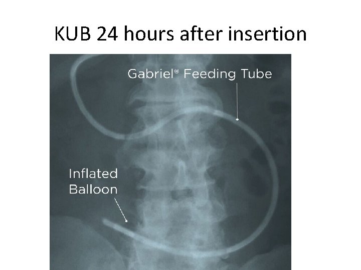 KUB 24 hours after insertion 