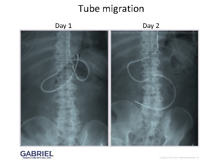 Tube migration Day 1 Day 2 