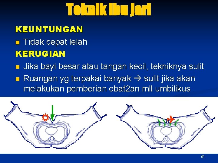 Teknik ibu jari KEUNTUNGAN n Tidak cepat lelah KERUGIAN n Jika bayi besar atau