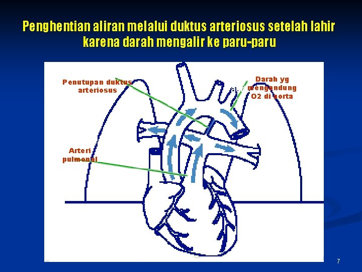 Penghentian aliran melalui duktus arteriosus setelah lahir karena darah mengalir ke paru-paru Penutupan duktus