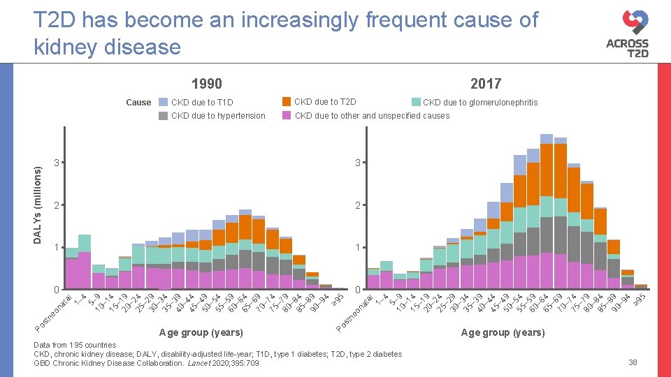 T 2 D has become an increasingly frequent cause of kidney disease 1990 CKD