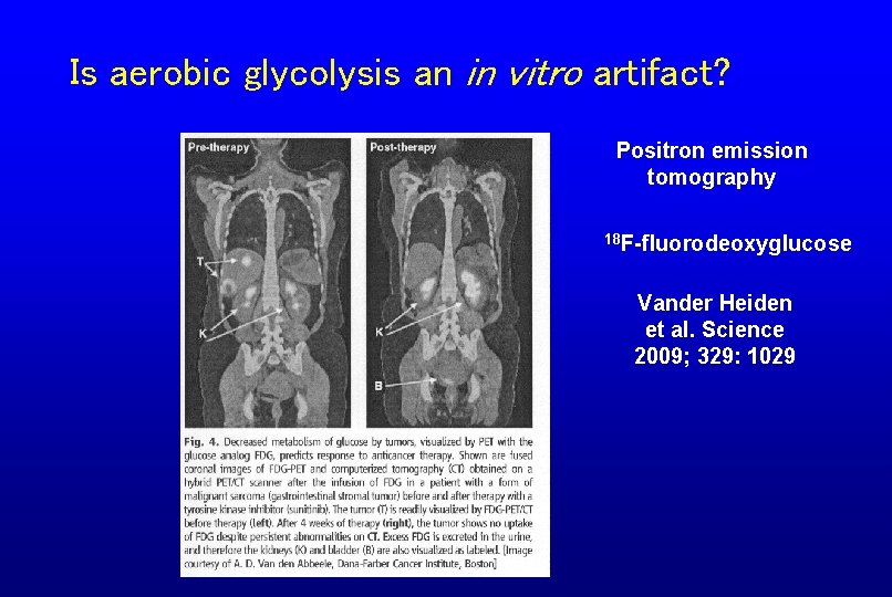 Is aerobic glycolysis an in vitro artifact? Positron emission tomography 18 F-fluorodeoxyglucose Vander Heiden