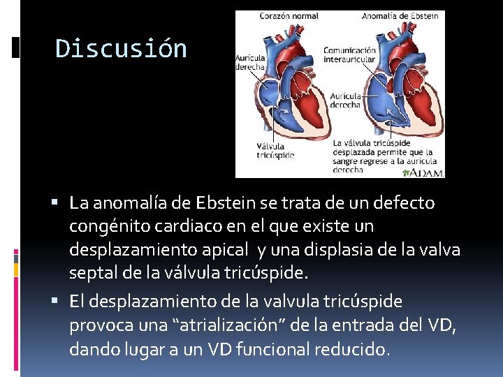 Discusión La anomalía de Ebstein se trata de un defecto congénito cardiaco en el