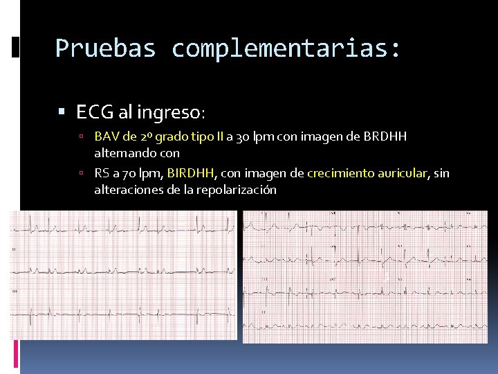 Pruebas complementarias: ECG al ingreso: BAV de 2º grado tipo II a 30 lpm