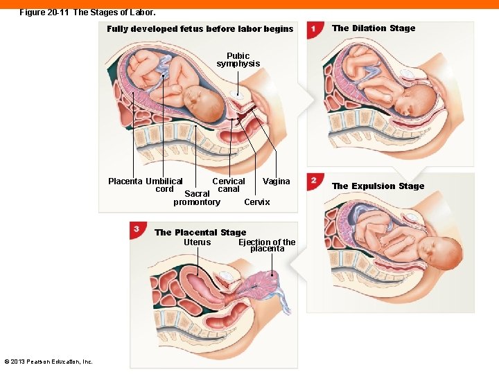 Figure 20 -11 The Stages of Labor. Fully developed fetus before labor begins The