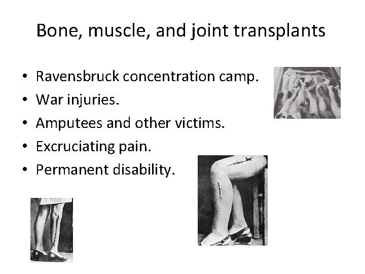 Bone, muscle, and joint transplants • • • Ravensbruck concentration camp. War injuries. Amputees