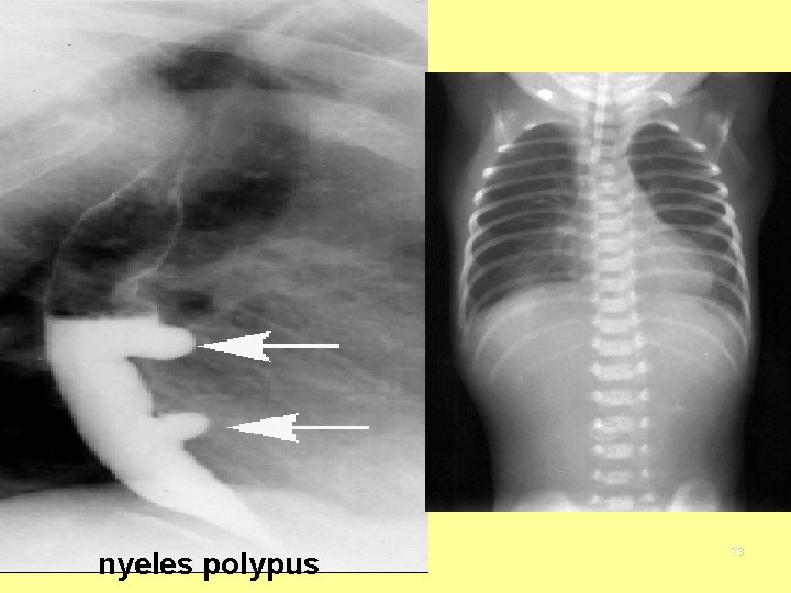 nyeles polypus 73 sessilis polypusok 