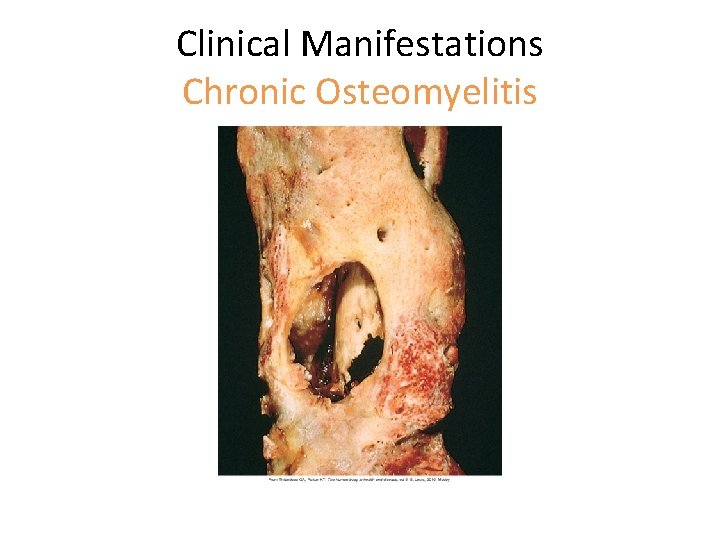 Clinical Manifestations Chronic Osteomyelitis 
