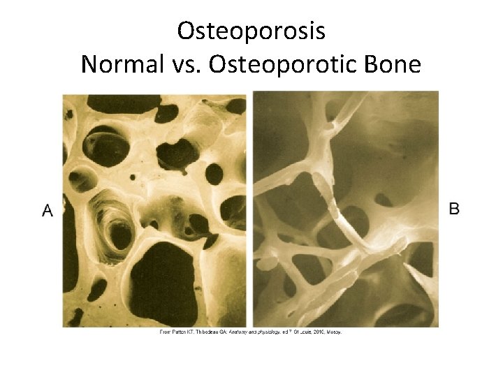 Osteoporosis Normal vs. Osteoporotic Bone 