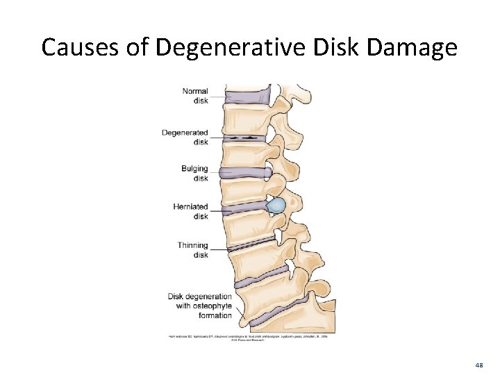 Causes of Degenerative Disk Damage 48 
