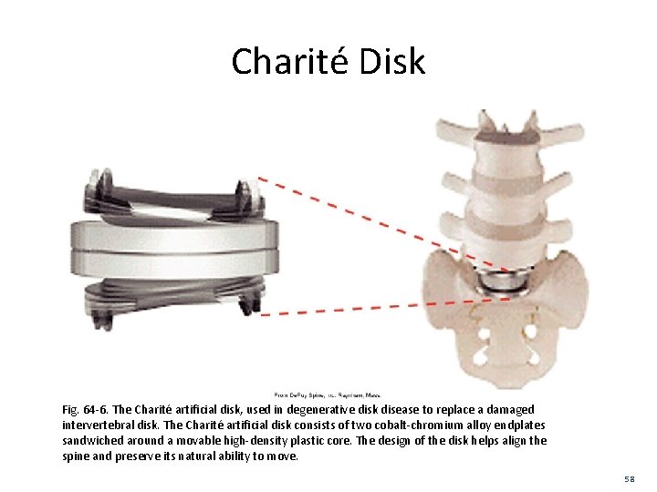 Charité Disk Fig. 64 -6. The Charité artificial disk, used in degenerative disk disease