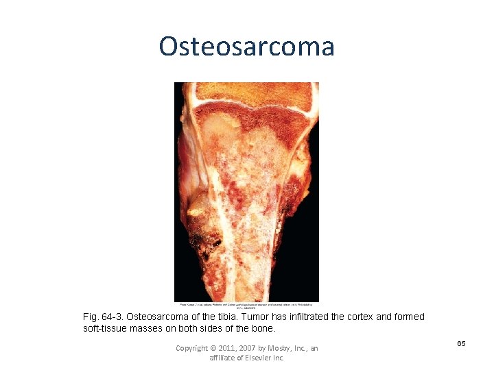 Osteosarcoma Fig. 64 -3. Osteosarcoma of the tibia. Tumor has infiltrated the cortex and