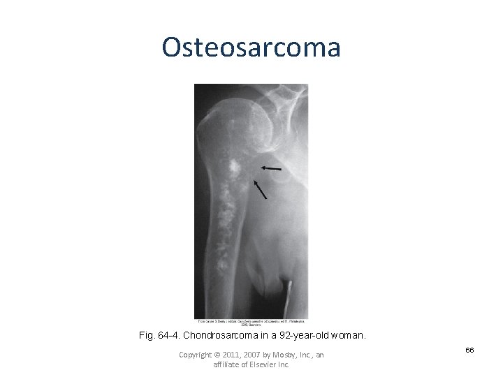 Osteosarcoma Fig. 64 -4. Chondrosarcoma in a 92 -year-old woman. Copyright © 2011, 2007