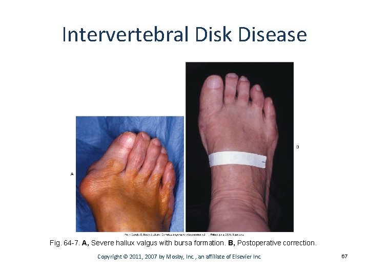 Intervertebral Disk Disease Fig. 64 -7. A, Severe hallux valgus with bursa formation. B,