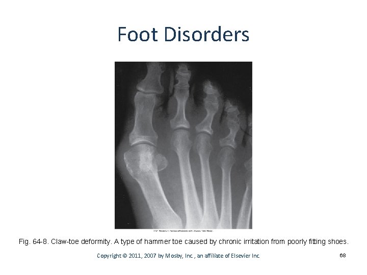 Foot Disorders Fig. 64 -8. Claw-toe deformity. A type of hammer toe caused by