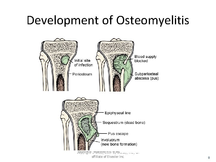 Development of Osteomyelitis Copyright © 2011, 2007 by Mosby, Inc. , an affiliate of