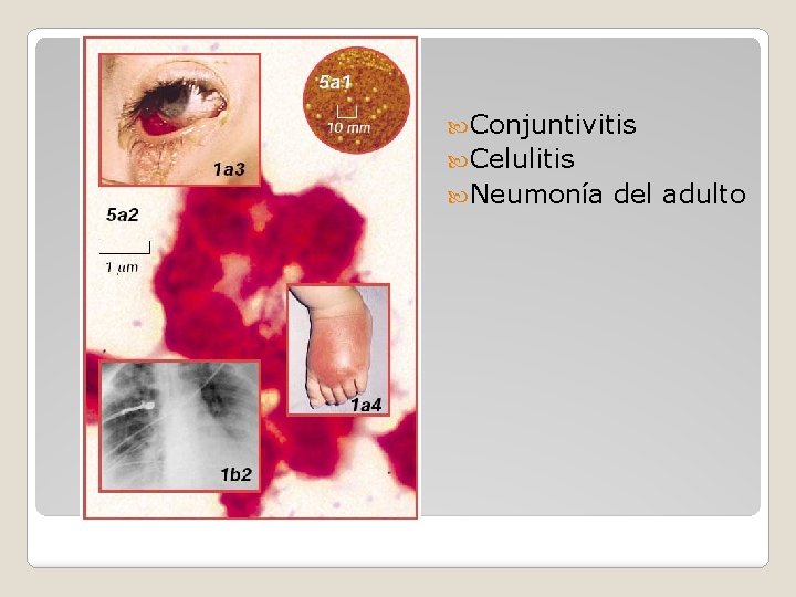  Conjuntivitis Celulitis Neumonía del adulto 
