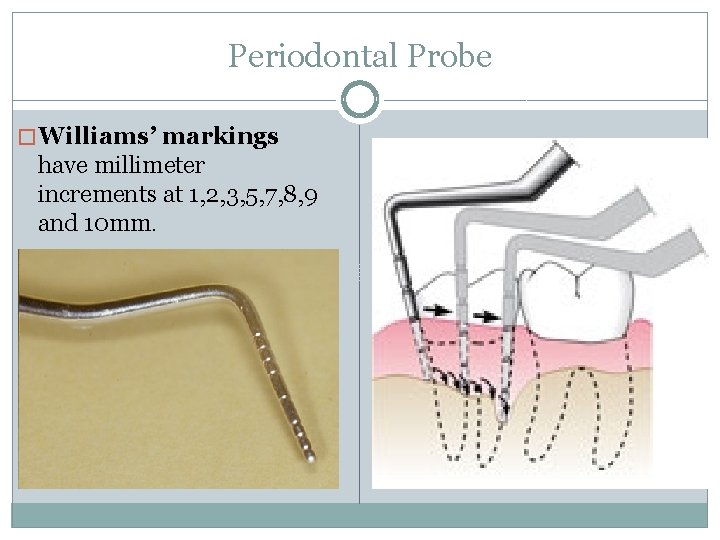 Periodontal Probe � Williams’ markings have millimeter increments at 1, 2, 3, 5, 7,