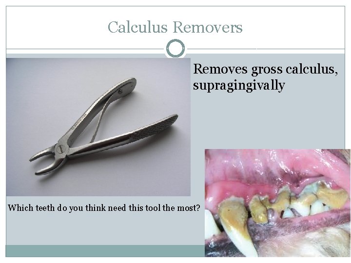 Calculus Removers Removes gross calculus, supragingivally Which teeth do you think need this tool