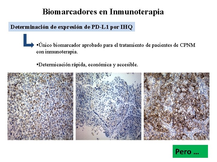 Biomarcadores en Inmunoterapia Determinación de expresión de PD-L 1 por IHQ §Único biomarcador aprobado