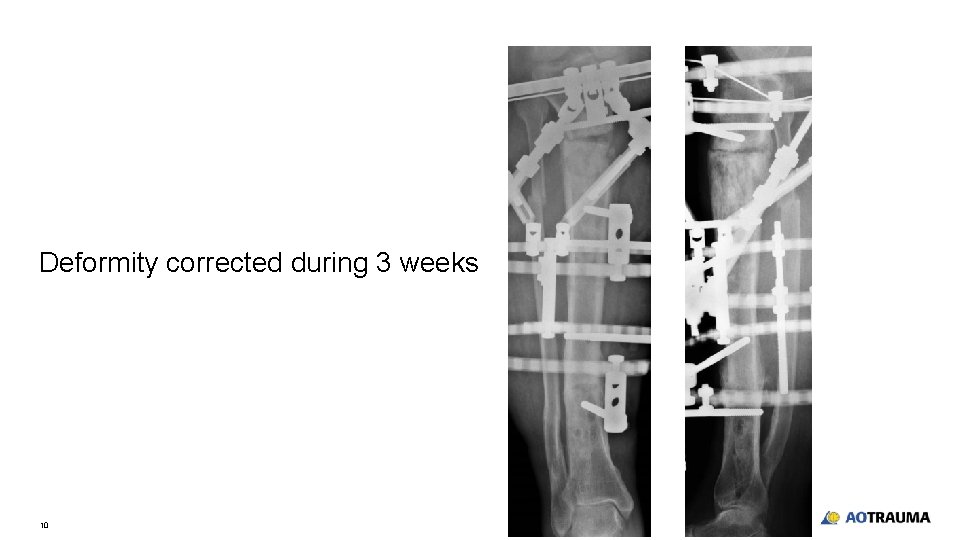 Deformity corrected during 3 weeks 10 