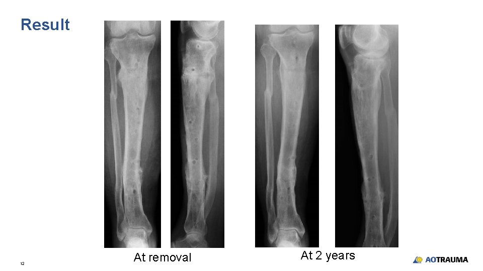 Result 12 At removal At 2 years 