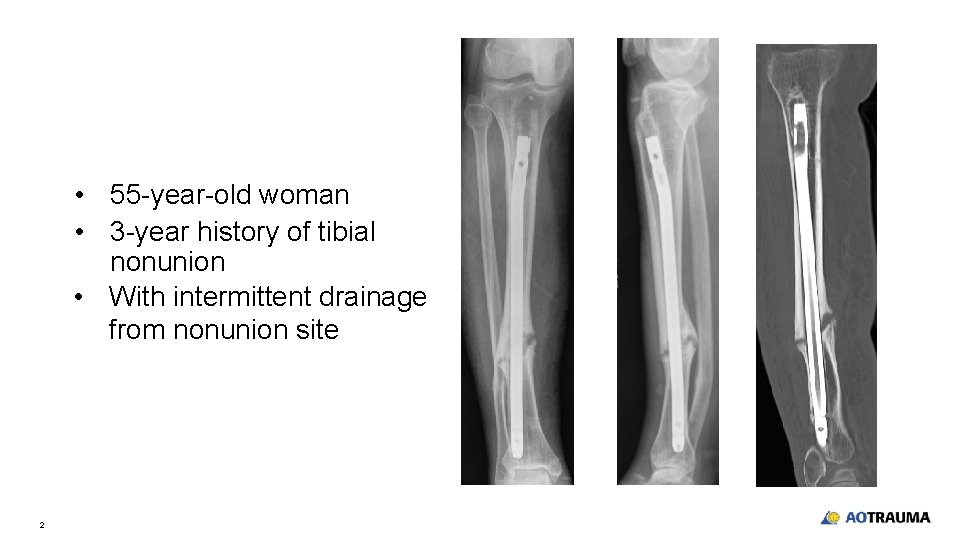  • 55 -year-old woman • 3 -year history of tibial nonunion • With
