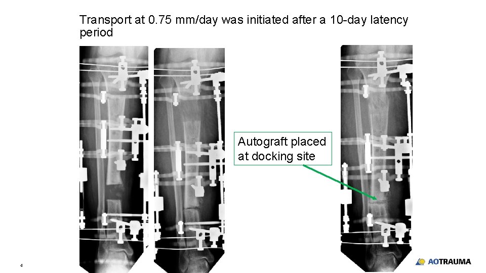 Transport at 0. 75 mm/day was initiated after a 10 -day latency period Autograft