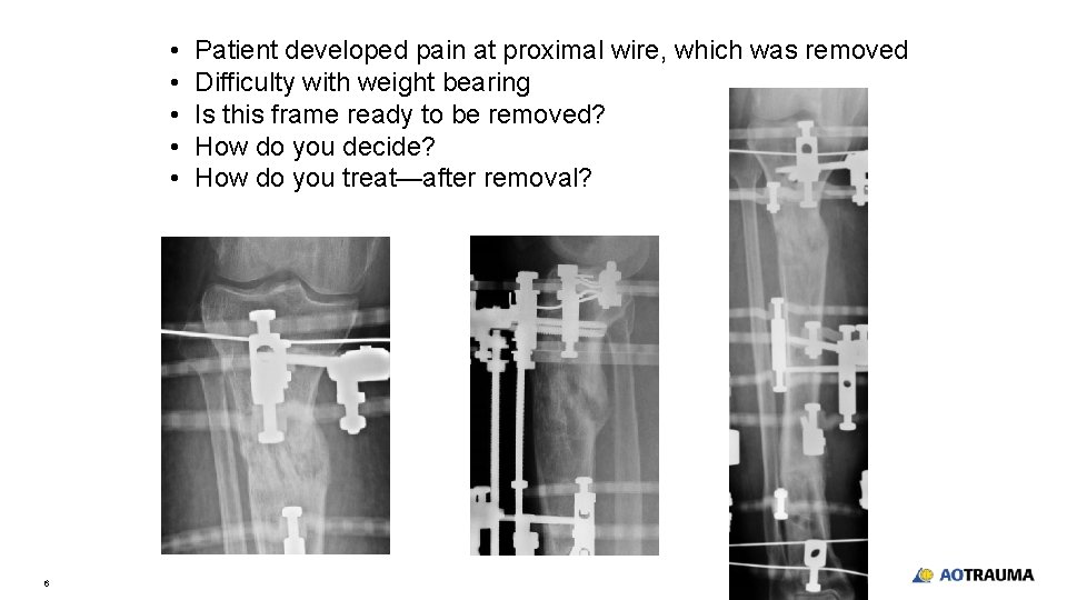  • • • 6 Patient developed pain at proximal wire, which was removed