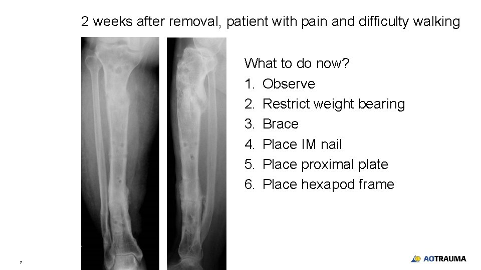 2 weeks after removal, patient with pain and difficulty walking What to do now?