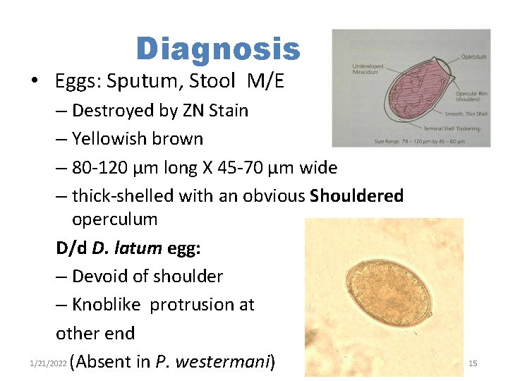 Diagnosis • Eggs: Sputum, Stool M/E – Destroyed by ZN Stain – Yellowish brown