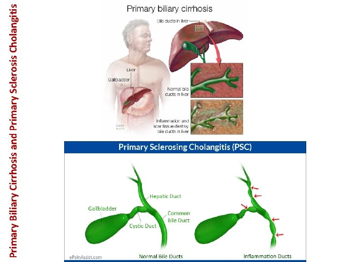 Primary Biliary Cirrhosis and Primary Sclerosis Cholangitis 