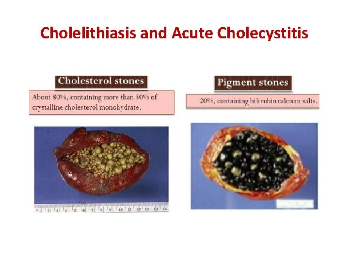 Cholelithiasis and Acute Cholecystitis 