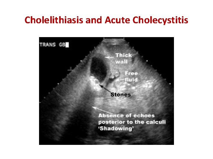 Cholelithiasis and Acute Cholecystitis 