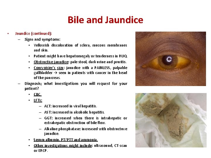 Bile and Jaundice • Jaundice (continued): – Signs and symptoms: • Yellowish discoloration of