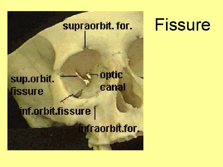 Fissure 