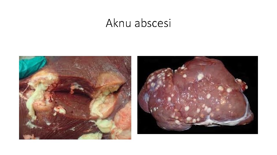 Aknu abscesi 