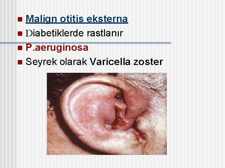 Malign otitis eksterna n Diabetiklerde rastlanır n P. aeruginosa n Seyrek olarak Varicella zoster