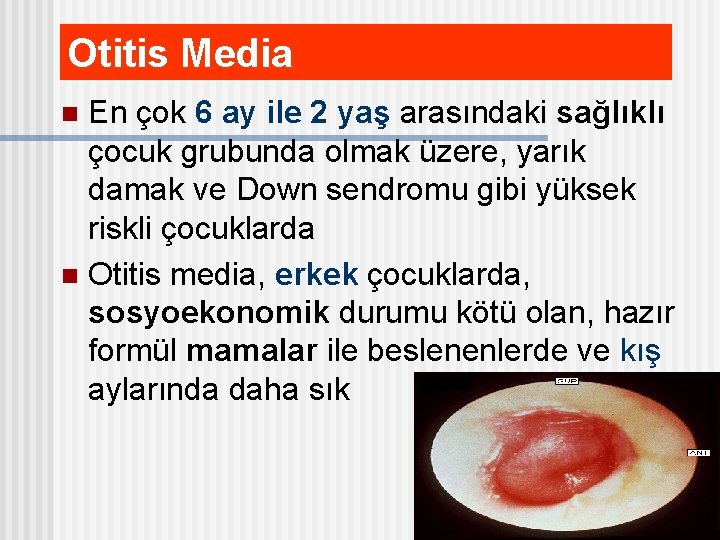 Otitis Media En çok 6 ay ile 2 yaş arasındaki sağlıklı çocuk grubunda olmak