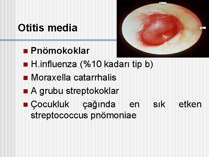 Otitis media Pnömokoklar n H. influenza (%10 kadarı tip b) n Moraxella catarrhalis n