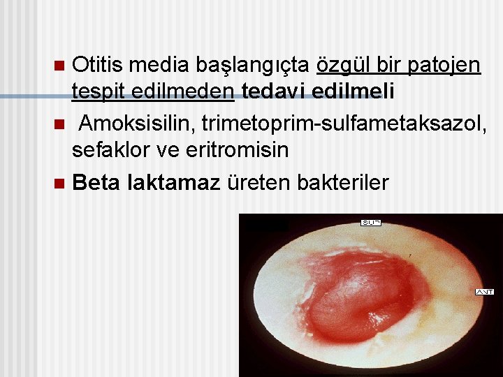 Otitis media başlangıçta özgül bir patojen tespit edilmeden tedavi edilmeli n Amoksisilin, trimetoprim-sulfametaksazol, sefaklor