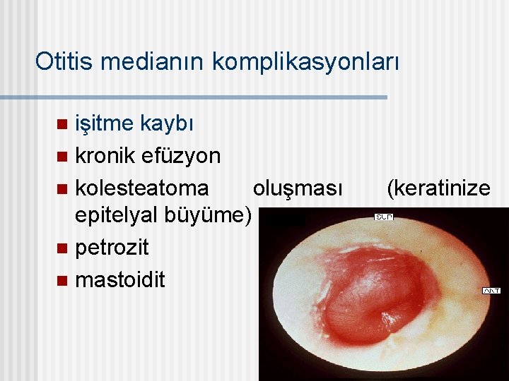 Otitis medianın komplikasyonları işitme kaybı n kronik efüzyon n kolesteatoma oluşması epitelyal büyüme) n