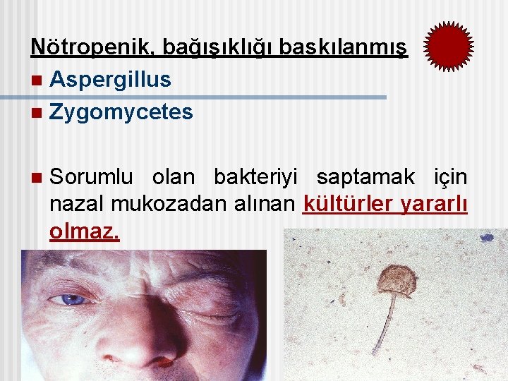 Nötropenik, bağışıklığı baskılanmış n Aspergillus n Zygomycetes n Sorumlu olan bakteriyi saptamak için nazal