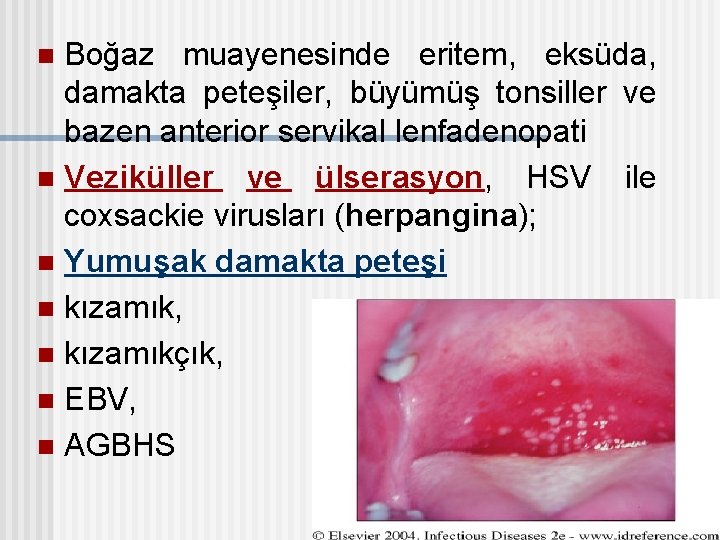 Boğaz muayenesinde eritem, eksüda, damakta peteşiler, büyümüş tonsiller ve bazen anterior servikal lenfadenopati n