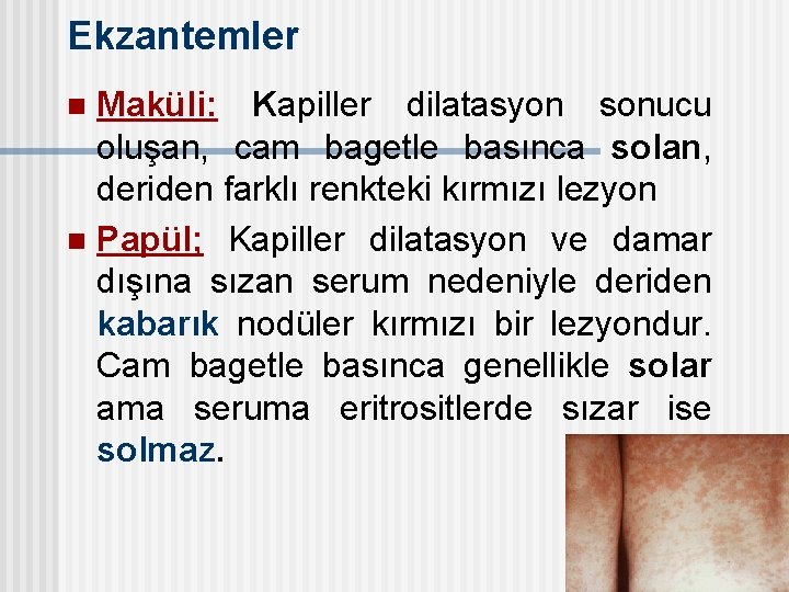 Ekzantemler Maküli: Kapiller dilatasyon sonucu oluşan, cam bagetle basınca solan, deriden farklı renkteki kırmızı