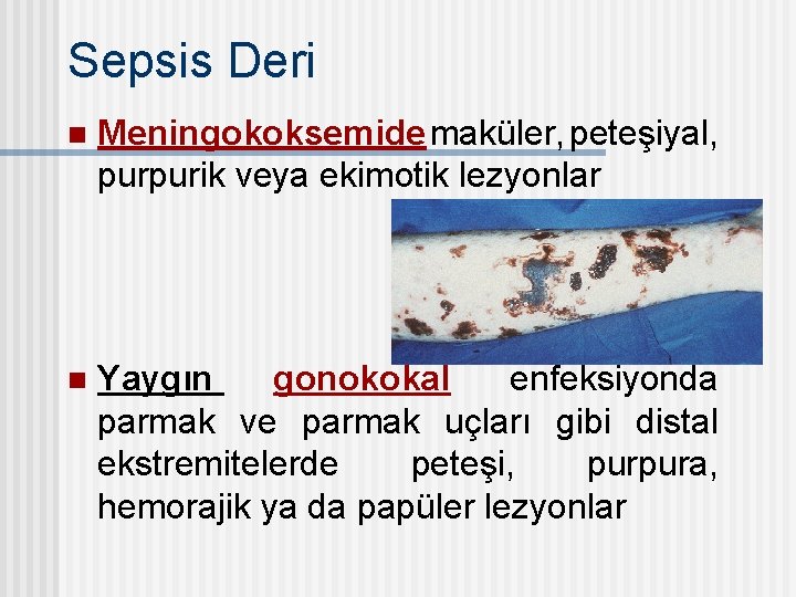 Sepsis Deri n Meningokoksemide maküler, peteşiyal, purpurik veya ekimotik lezyonlar n Yaygın gonokokal enfeksiyonda