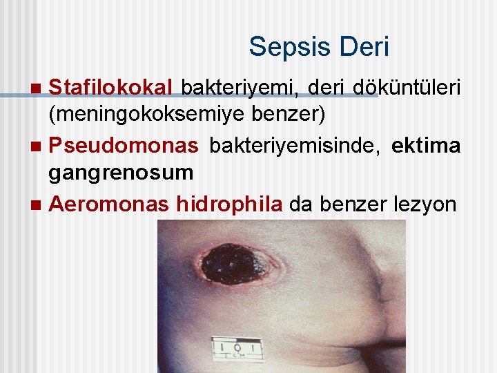 Sepsis Deri Stafilokokal bakteriyemi, deri döküntüleri (meningokoksemiye benzer) n Pseudomonas bakteriyemisinde, ektima gangrenosum n