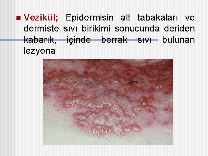 n Vezikül; Epidermisin alt tabakaları ve dermiste sıvı birikimi sonucunda deriden kabarık, içinde berrak