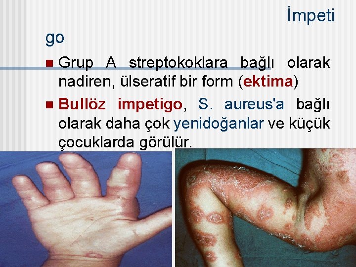 İmpeti go Grup A streptokoklara bağlı olarak nadiren, ülseratif bir form (ektima) n Bullöz