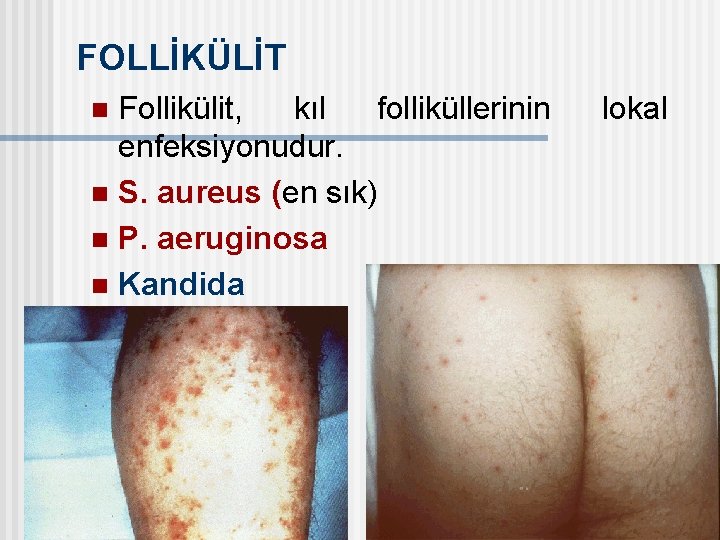 FOLLİKÜLİT Follikülit, kıl folliküllerinin enfeksiyonudur. n S. aureus (en sık) n P. aeruginosa n